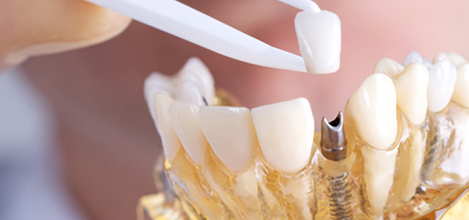Clínica colombiana de Implantes dentales
