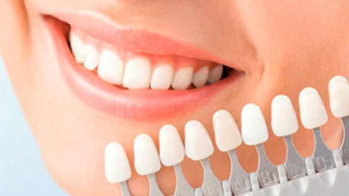Recomendaciones para blanqueamiento de dientes