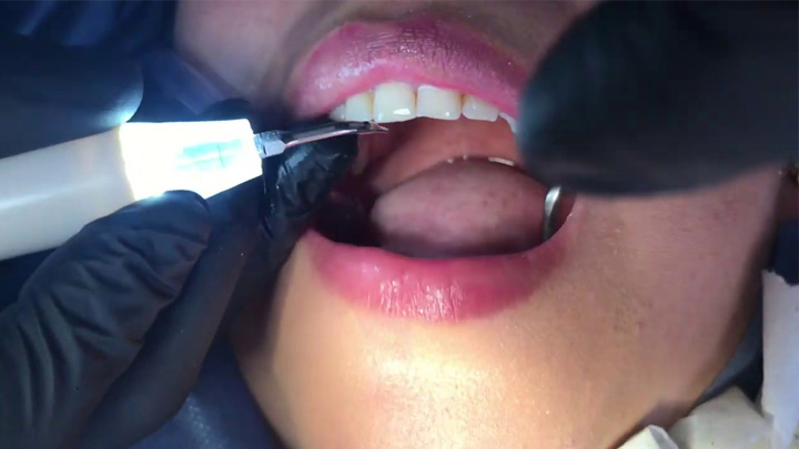 ¿Qué es Limpieza dental con Ultrasonido?