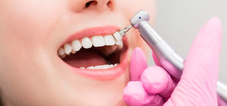Limpieza dental con Ultrasonido